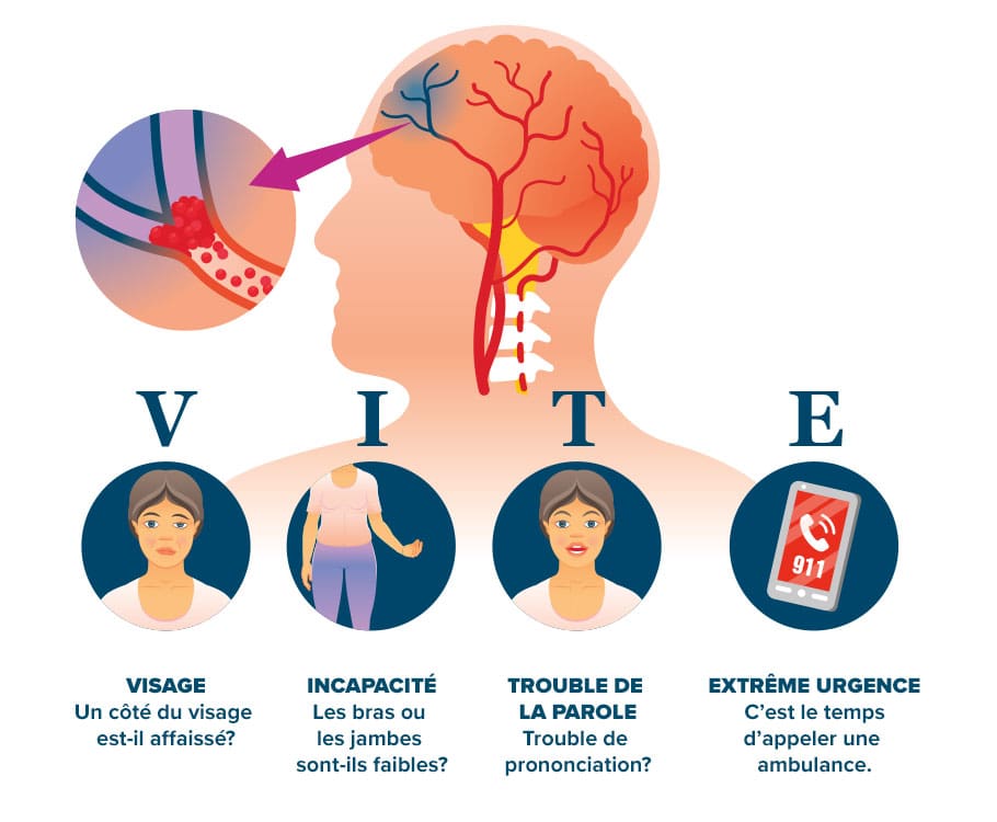 illustration of stroke symptoms
